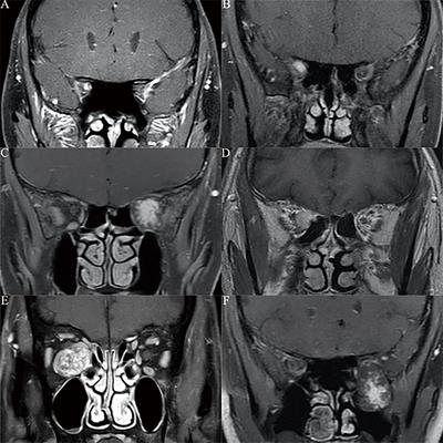 Prognosis Analysis and Clinical Features of Orbital Cavernous Venous Malformations With Refractory <mark class="highlighted">Insidious Onset</mark>